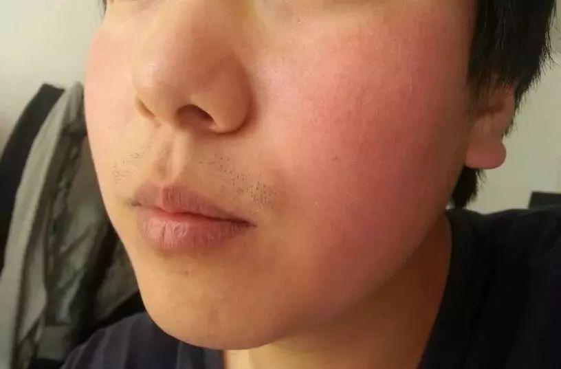 危險邊緣型紅血絲 紅血絲的種類有哪些?