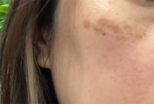 祛斑反黑色素沉著怎么消除？